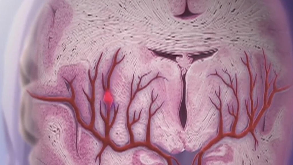 Knowing the signs of a stroke can save lives — Canton Community news